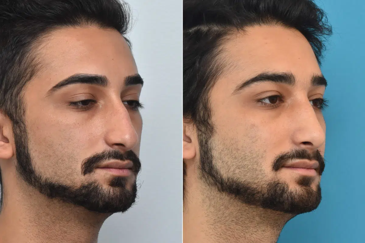 Rhinoplasty Before and After Photos in Philadelphia, PA, Patient 1466