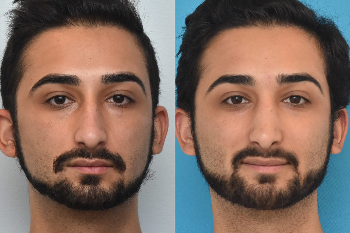 Rhinoplasty Before and After Photos in Philadelphia, PA, Patient 1466