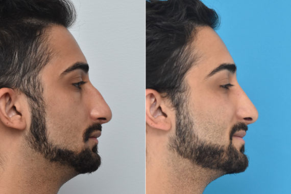 Rhinoplasty Before and After Photos in Philadelphia, PA, Patient 1466