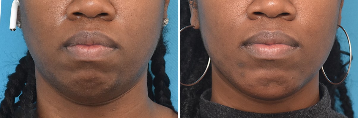 Chin Implant Before And After The Ultimate Chin Augmentation Guide - 27485rn