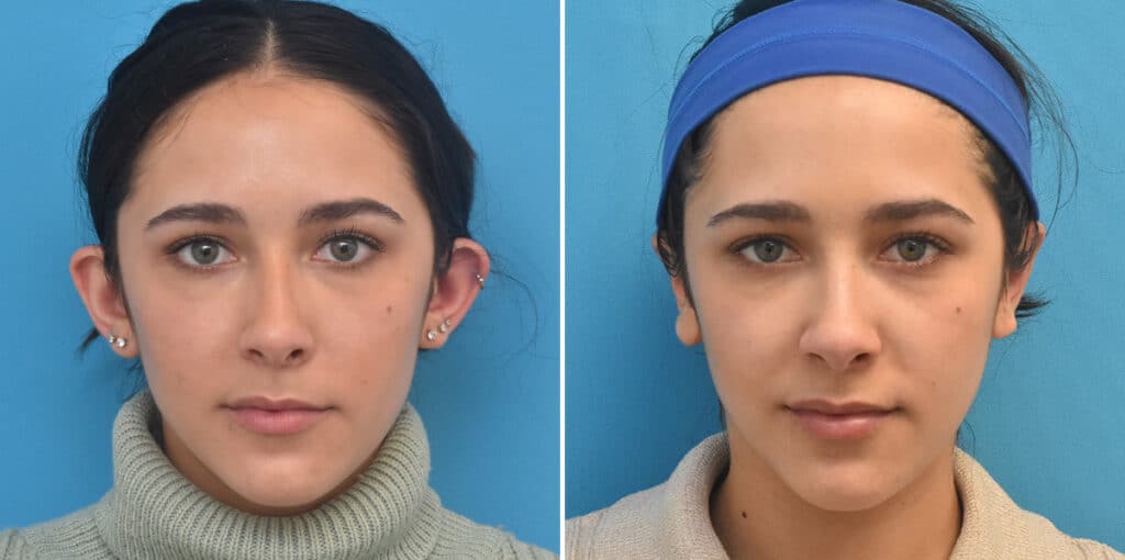 Before and After Photos - Kirk Lozada, MD, Facial Plastic Surgery