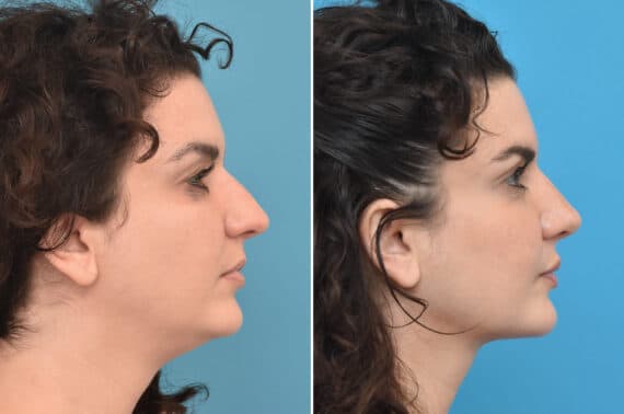 Rhinoplasty Before and After Photos in Philadelphia, PA, Patient 3866