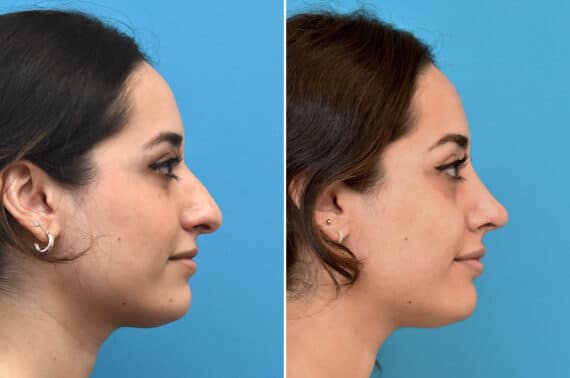 Rhinoplasty Before and After Photos in Philadelphia, PA, Patient 3883