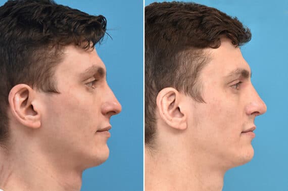 Rhinoplasty Before and After Photos in Philadelphia, PA, Patient 3885