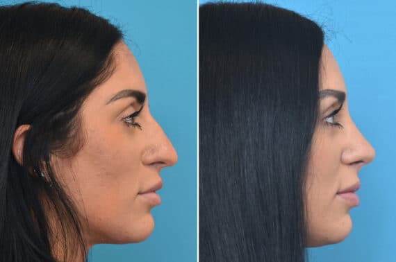 Rhinoplasty Before and After Photos in Philadelphia, PA, Patient 3892