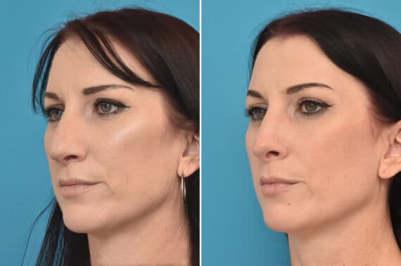 Rhinoplasty Before and After Photos in Philadelphia, PA, Patient 3909