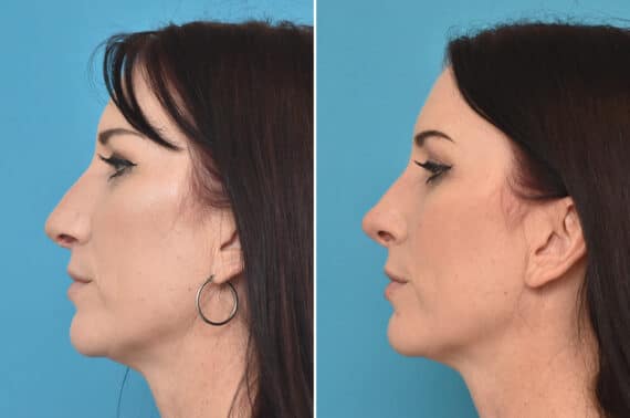 Rhinoplasty Before and After Photos in Philadelphia, PA, Patient 3909