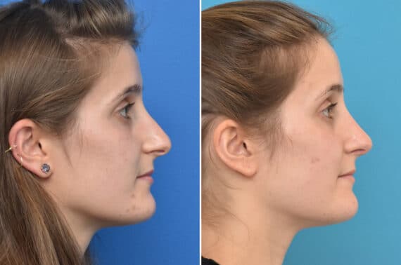 Rhinoplasty Before and After Photos in Philadelphia, PA, Patient 3931