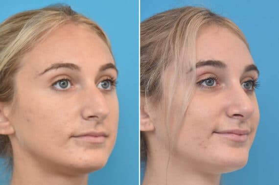 Rhinoplasty Before and After Photos in Philadelphia, PA, Patient 3940