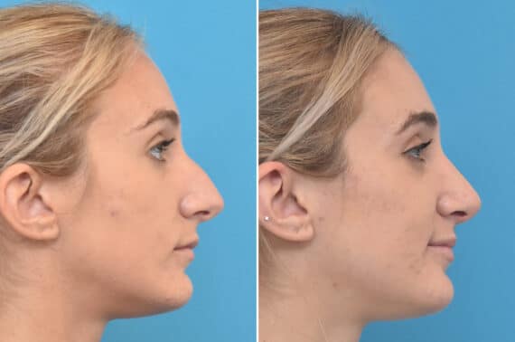 Rhinoplasty Before and After Photos in Philadelphia, PA, Patient 3940