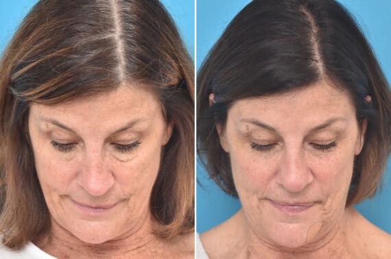 Rhinoplasty Before and After Photos in Philadelphia, PA, Patient 3942