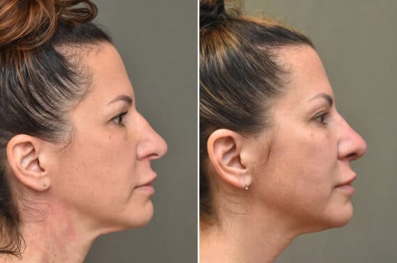 Rhinoplasty Before and After Photos in Philadelphia, PA, Patient 3970