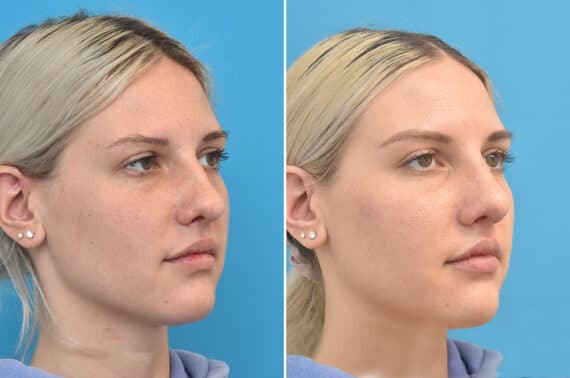 Rhinoplasty Before and After Photos in Philadelphia, PA, Patient 3971