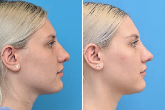 Rhinoplasty Before and After Photos in Philadelphia, PA, Patient 3971