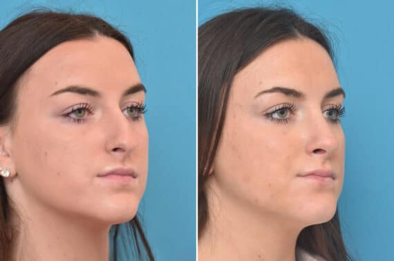 Rhinoplasty Before and After Photos in Philadelphia, PA, Patient 3972