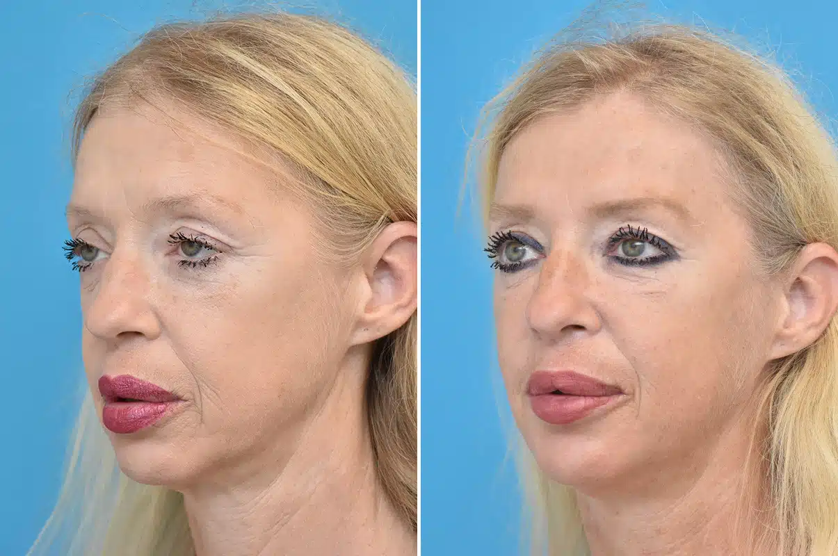 Sculptra Before and After photo gallery