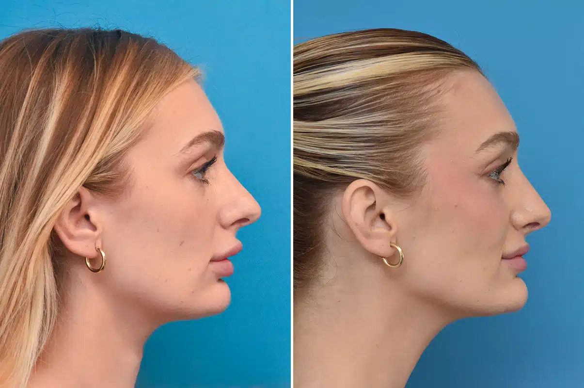 Before and After Photos - Kirk Lozada, MD, Facial Plastic Surgery