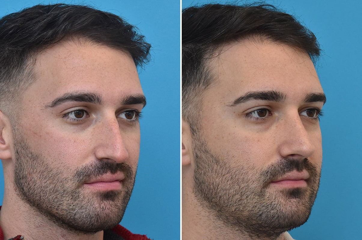 Discover Male Revision Rhinoplasty Surgery Success