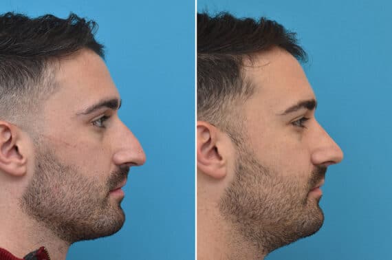 Rhinoplasty Before and After Photos in Philadelphia, PA, Patient 5217