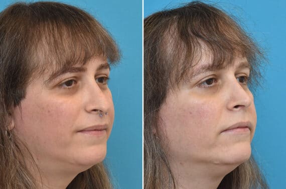 Rhinoplasty Before and After Photos in Philadelphia, PA, Patient 5236