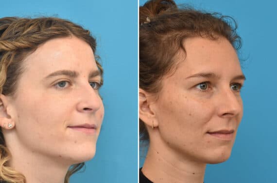 Rhinoplasty Before and After Photos in Philadelphia, PA, Patient 5244