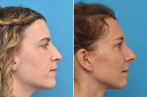 Rhinoplasty Before and After Photos in Philadelphia, PA, Patient 5244