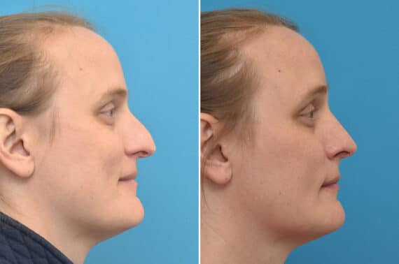 Rhinoplasty Before and After Photos in Philadelphia, PA, Patient 5273