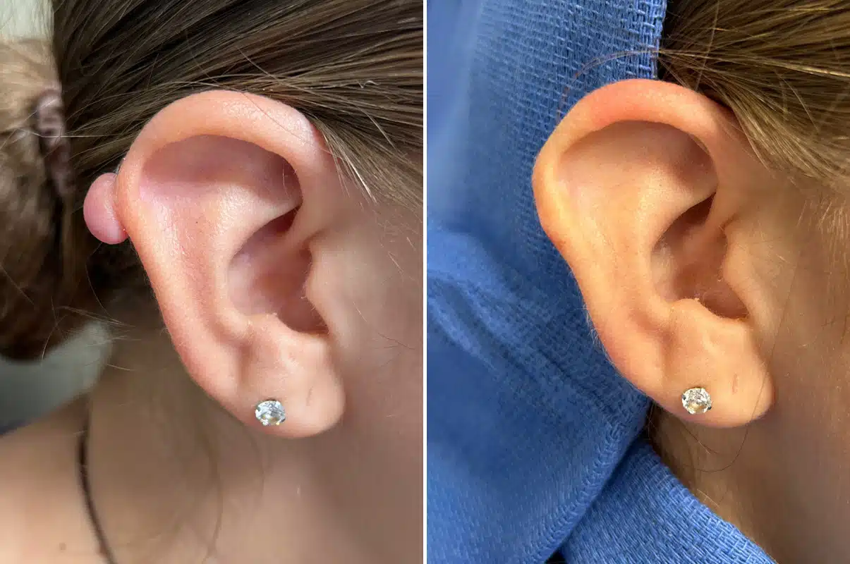 Ear Lobe Repair photos Philadelphia, PA Patient 5356