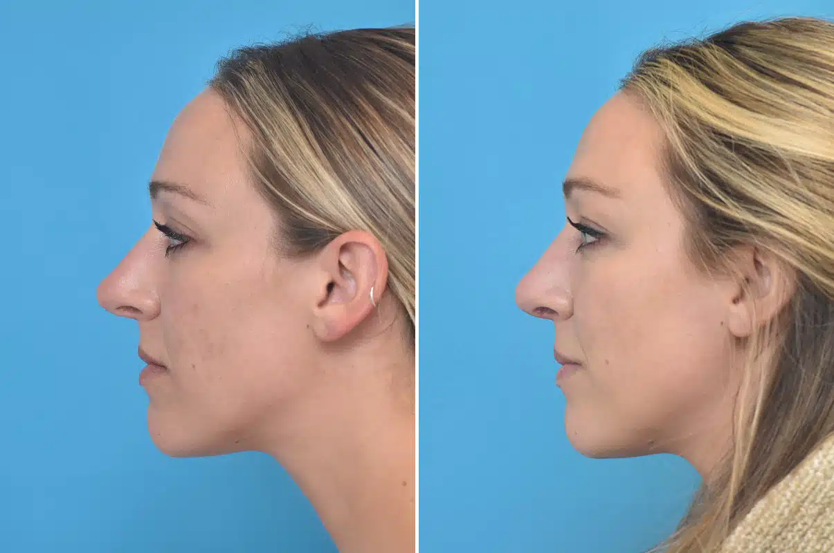 Before and After Photos - Kirk Lozada, MD, Facial Plastic Surgery