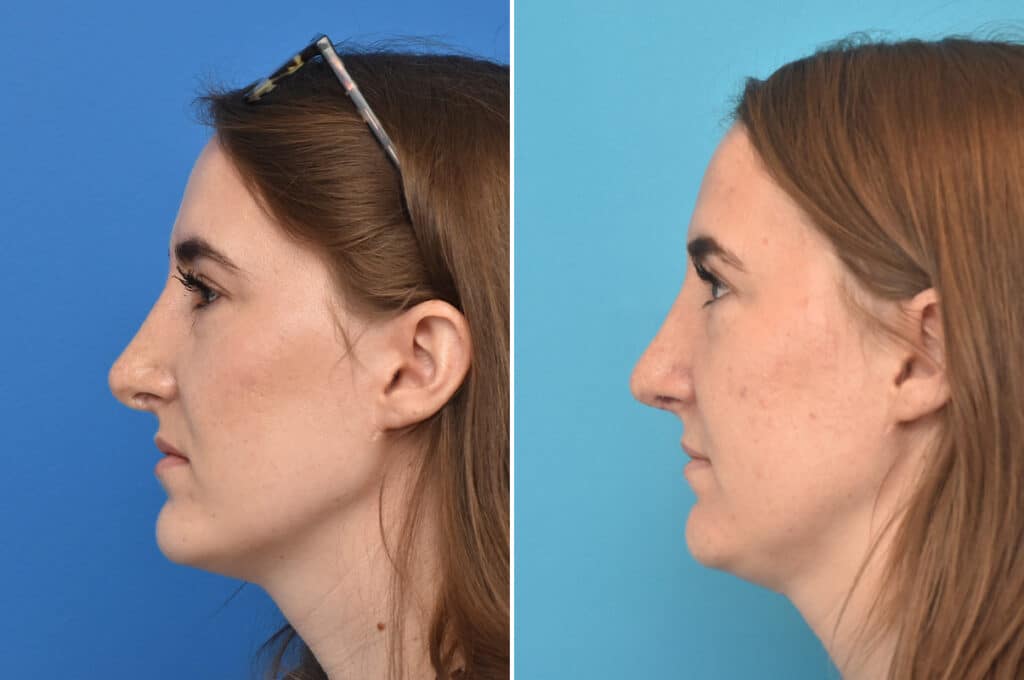Before and After Photos - Kirk Lozada, MD, Facial Plastic Surgery