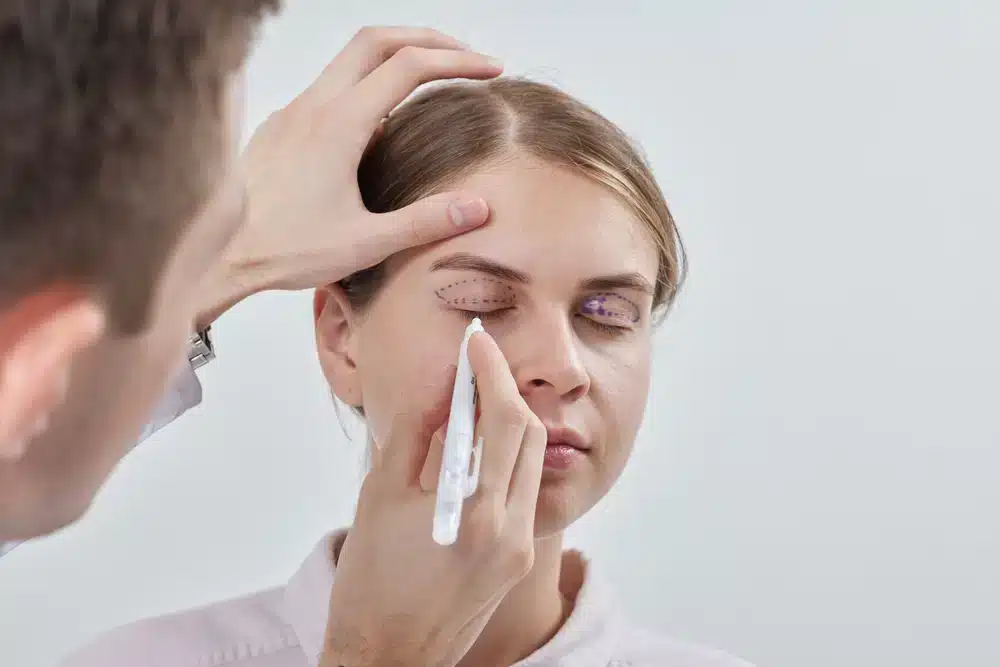 Surgeon marking upper eyelids on a female patient in preparation for cosmetic blepharoplasty procedure