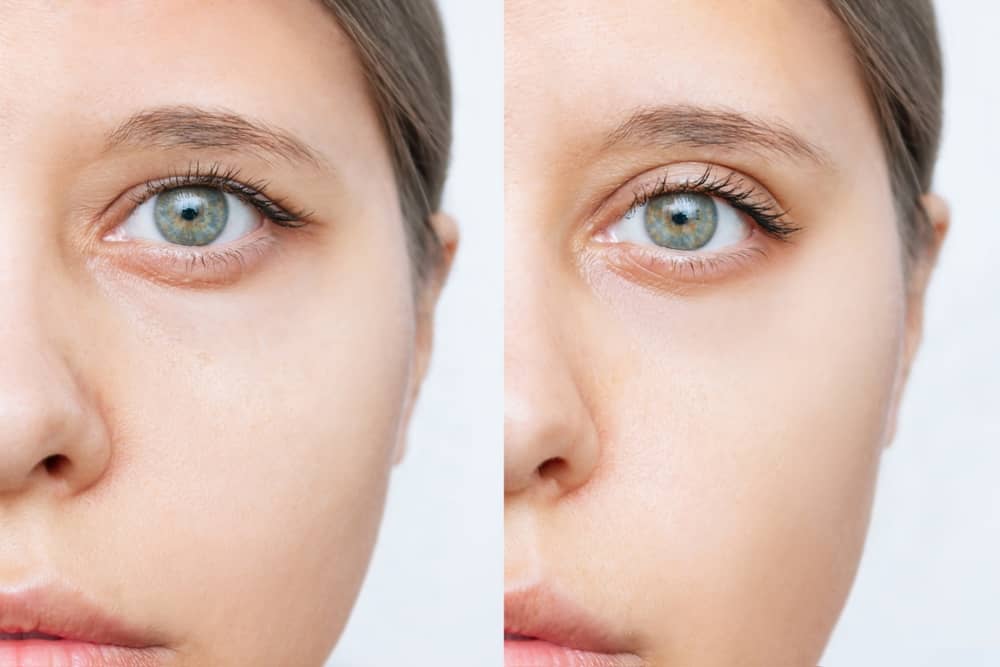 After your blepharoplasty for hooded eyes you will notice excellent results on your face and an increase in confidence