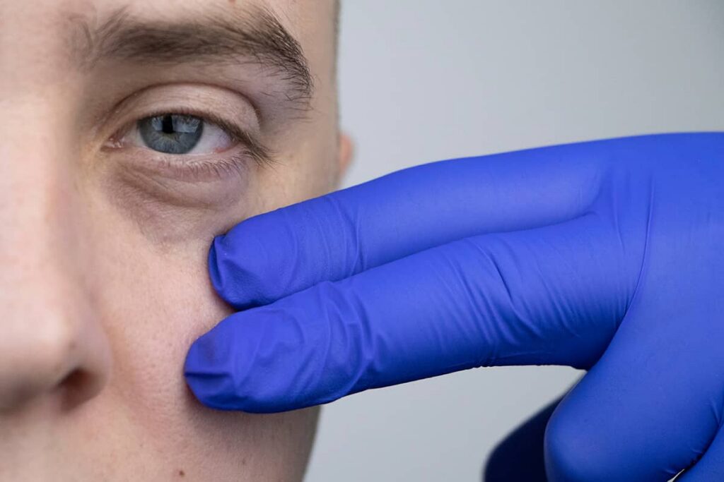 In rare cases, patients may experience temporary eyelid drooping or muscle weakness around the eyes after receiving a Botox injection for under-eye bags