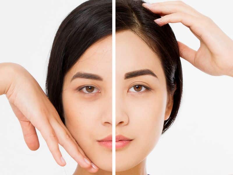Before and after comparison of a woman's face, showcasing results of an endoscopic brow lift procedure.