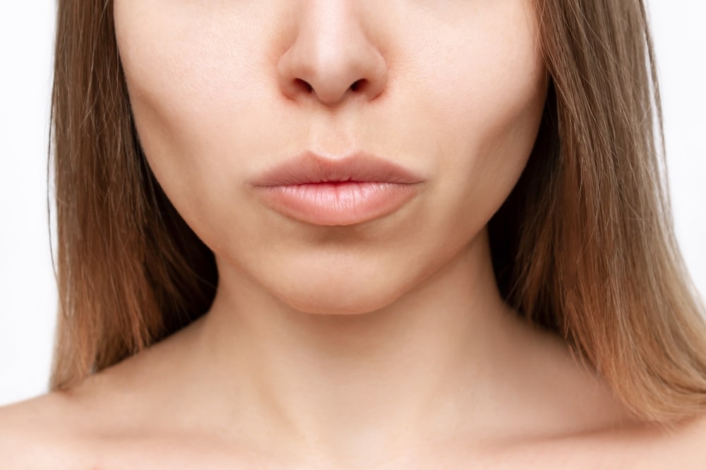 Woman's face showing mild swelling after buccal fat removal, highlighting early post-operative recovery phase.