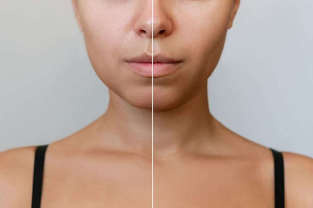 Side-by-side comparison of a woman's face before and after buccal fat removal, showing a slimmer contour.