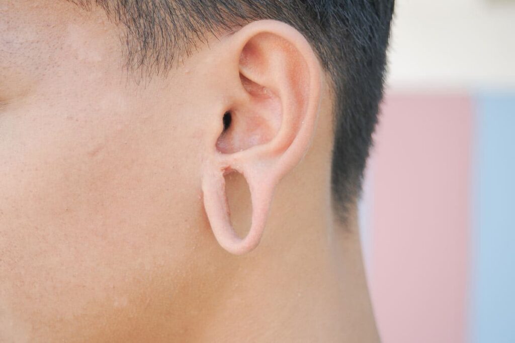 Earlobe repair patient with severe damage to the earlobe caused by heavy earrings or tunnels