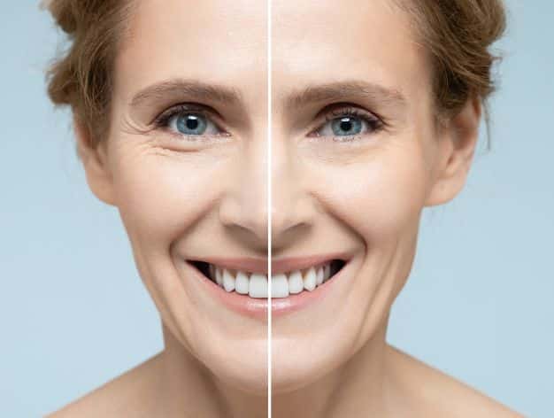 Split-image of a woman’s face showing before-and-after effects of fine line treatments in the infraorbital area.