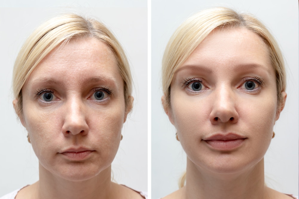 Side-by-side before-and-after images of a woman showing improved facial appearance after scar healing.