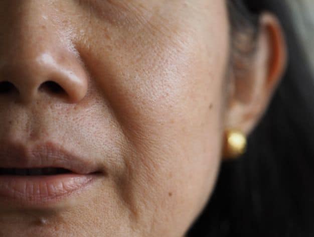 Close-up of a woman's nasolabial folds, highlighting skin texture and potential treatment options like fillers.