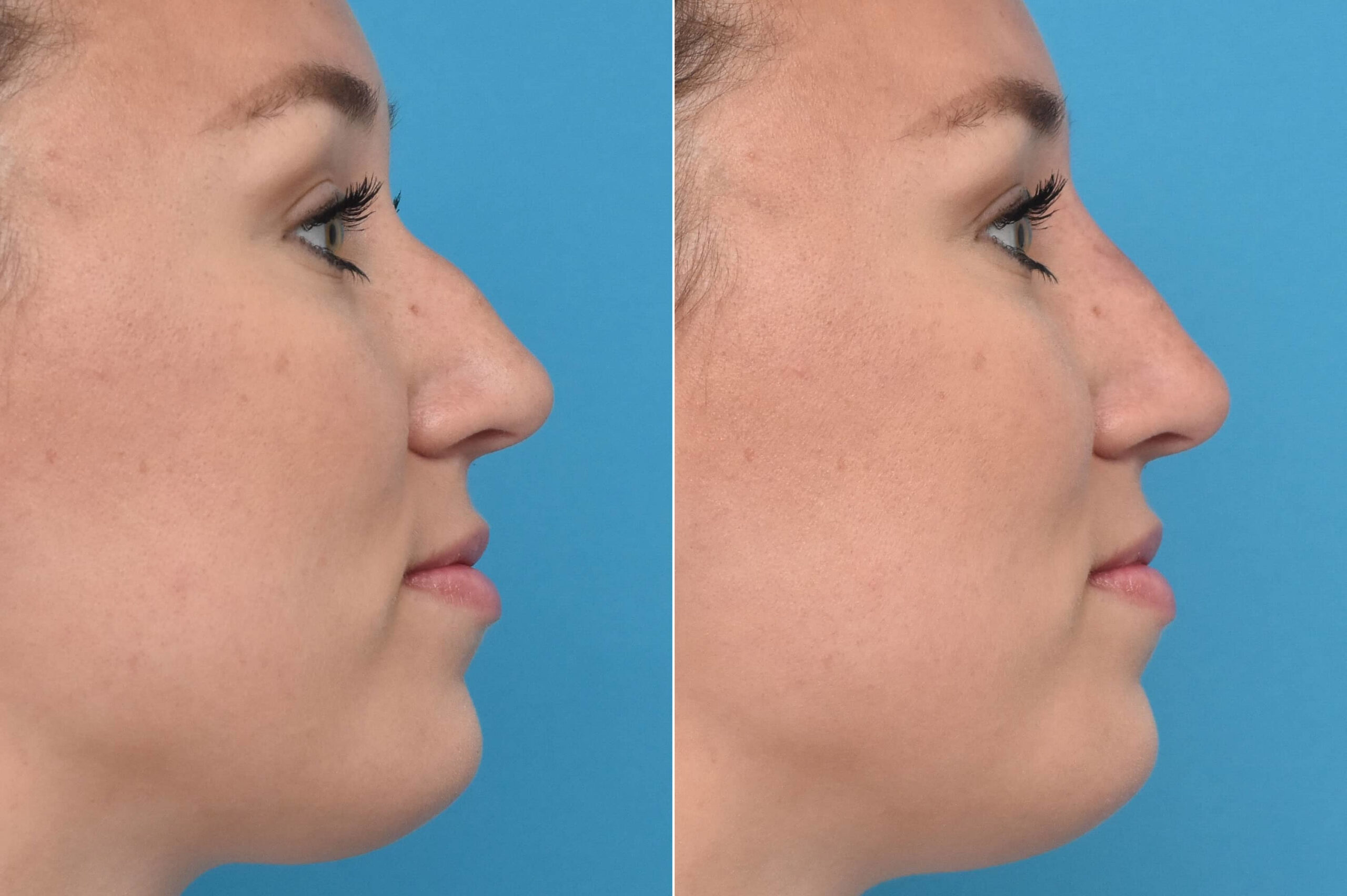 Side-by-side before-and-after images of a woman’s nose after non-surgical rhinoplasty using dermal fillers.