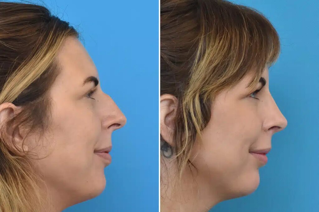 Side-by-side before-and-after images of a woman’s nose correction, highlighting causes of nasal asymmetry.