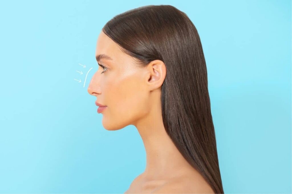 Woman with nasal hump in profile view, illustrating common causes such as genetics, injuries, and developmental changes.