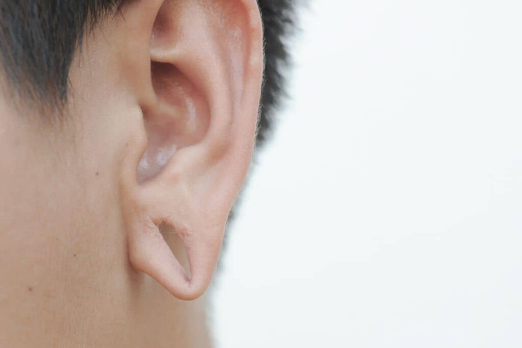 Close-up view of a split earlobe, illustrating damage suitable for surgical repair to restore earlobe shape.